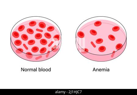 Normales Blut und anämisches Blut, Illustration Stockfoto