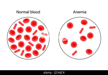 Normales Blut und anämisches Blut, Illustration Stockfoto