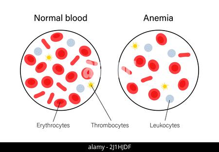 Normales Blut und anämisches Blut, Illustration Stockfoto