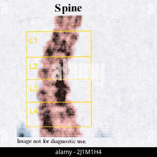 Nahaufnahme des DEXA-Tests - Osteodensimetrie der Wirbelsäule, die die Knochendichte mittels Röntgenstrahlen misst, wird zur Diagnose von Osteoporose verwendet Stockfoto