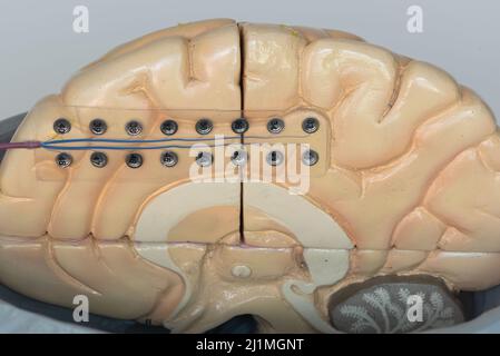 Nahaufnahme der Subduralelektrode zur Aufzeichnung von Gehirnwellen oder Elektroenzephalen auf der medialen Oberfläche der Gehirnhemisphäre. Stockfoto