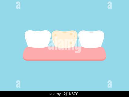 Weißer Zahn und ein Zahn mit gelbem Plaque-Symbol. Stock Vektor