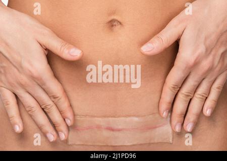 Nach der Operation am C-Schnitt ein Pflaster mit einer Silikonfolie auf ihre Narbe auftragen Stockfoto