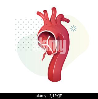 Aortenaneurysma - Stockillustration als EPS 10-Datei Stock Vektor