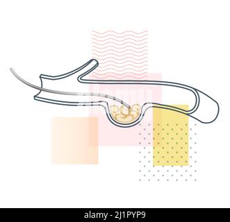 Aneurysma mit vaskulärem Stent-Verfahren – Stockdarstellung als EPS 10-Datei Stock Vektor
