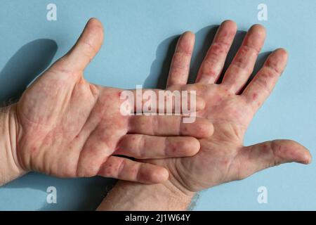 Schmerzhafter Ausschlag, rote Flecken Blasen auf der Hand. Nahaufnahme Allergieausschlag, menschliche Hände mit Dermatitis Gesundheitsproblem. Ekzemhaut des Patienten. Viruserkrankungen. Stockfoto