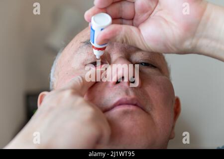 Ein Mann, der antibakterielle Augentropfen auf ein rot infiziertes Auge appiert. Stockfoto