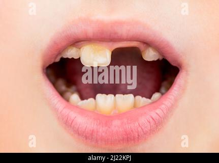 Kind mit schlechten Zähnen. Portrait Junge mit schlechten Zähnen. Kind lächelt und zeigt ihren gedrängten Zahn. Nahaufnahme von ungesunden Babyteugen. Kinderpatient hat offenen Mund Stockfoto