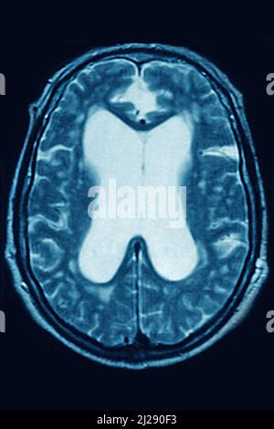 Hydrocepalus exvacuo Stockfoto