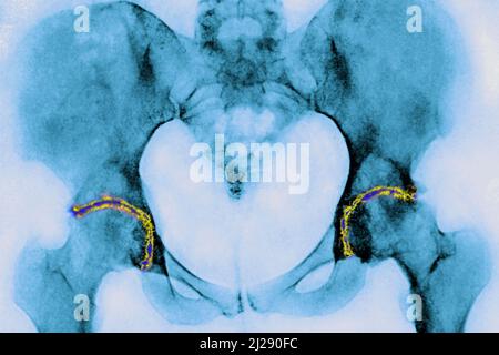 Arthrose der Hüften Stockfoto
