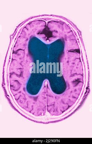 Hydrocepalus exvacuo Stockfoto