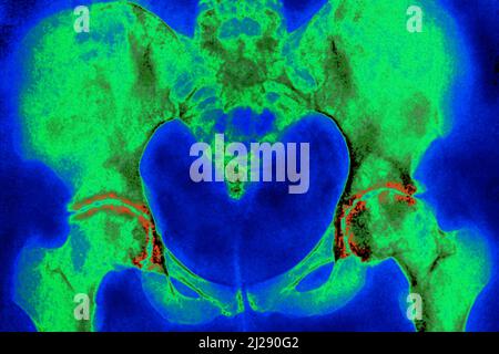 Arthrose der Hüften Stockfoto