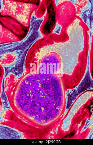 Prostatisches Adenom Stockfoto