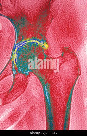 Arthrose der Hüfte Stockfoto