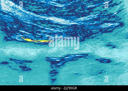 Aortenatherom Stockfoto