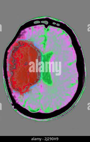 Schlaganfall Stockfoto