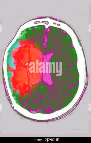 Schlaganfall Stockfoto