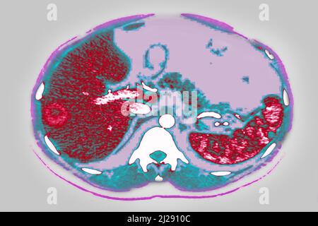 Lymphoreticulose Stockfoto