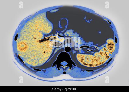 Lymphoreticulose Stockfoto