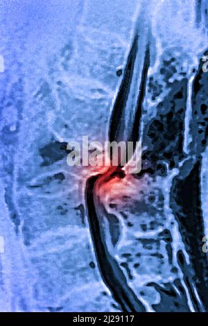 Dislokation Traumatismus Stockfoto