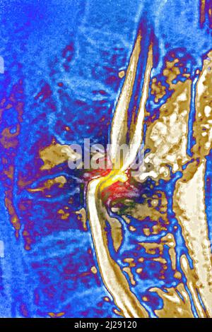 Dislokation Traumatismus Stockfoto