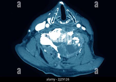 Maligner Tumor auf Halswirbeln lokalisiert Stockfoto