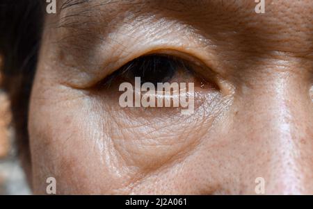 Prominente Fettbeutel und Falten unter den Augen des asiatischen älteren Mannes. Nahaufnahme. Stockfoto