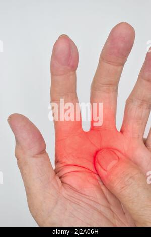 Schmerzhafter Palmaraspekt des asiatischen alten Mannes. Konzept des Kompartiment-Syndroms, Zellulitis und Schmerzen der Handmuskulatur. Stockfoto