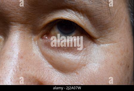 Prominente Fettbeutel und Falten unter den Augen des asiatischen älteren Mannes. Nahaufnahme. Stockfoto