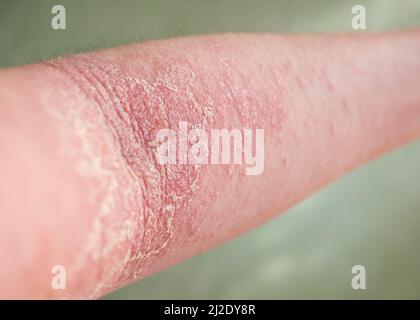 Nahaufnahme des Ekzems am Arm einer Person. Stockfoto