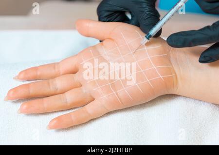 Professionelle Kosmetologie. Der Arzt gibt der weiblichen Handfläche Botulinumtoxin gegen Hyperhidrose injiziert. Hand mit weiß gezogenem Gitter. Nahaufnahme. Stockfoto