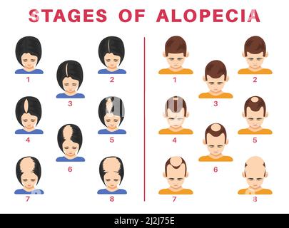 Phasen der Alopezie bei Männern und Frauen Vektor-Illustrationen-Set. Spitzen männlicher und weiblicher Köpfe mit kahlen Flecken auf schuppigen Stellen, isoliert auf weißem Hintergrund. Er Stock Vektor