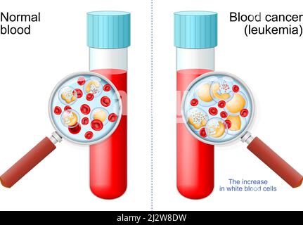 Leukämie. Rote und weiße Blutkörperchen in Reagenzglas in Lupe. Vergleich und Unterschied zwischen gesundem Blut und Blutkrebs Stock Vektor