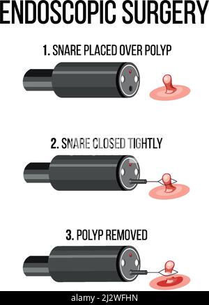 Abbildung zeigt die Illustration einer endoskopischen Operation Stock Vektor