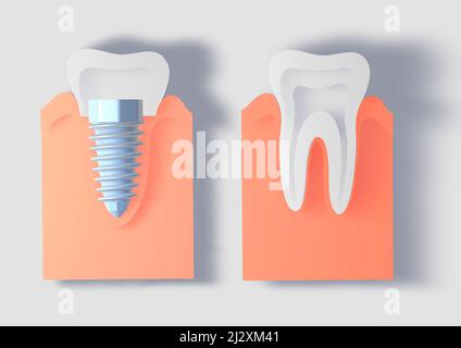 3D Darstellung eines Zahnimplantats in einem Zahnfleisch, neben einem normalen Zahn. Grafikstil simuliert geschnittenes Papier. Vorderansicht auf weißem Hintergrund. Stockfoto