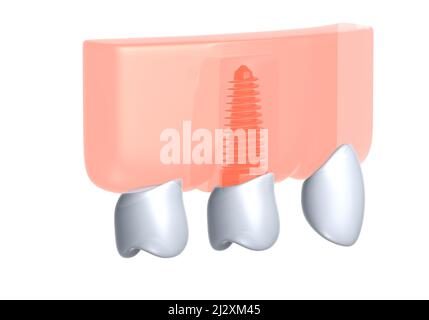 3D Illustration eines Zahnimplantats in einem Zahnfleisch. Ixometrischer Grafikstil. Anatomisches Bild der Prothese auf weißem Hintergrund. Stockfoto