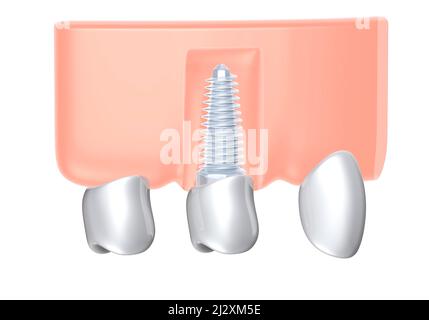 3D Illustration eines Zahnimplantats in einem Zahnfleisch. Ixometrischer Grafikstil. Anatomisches Bild der Prothese auf weißem Hintergrund. Stockfoto