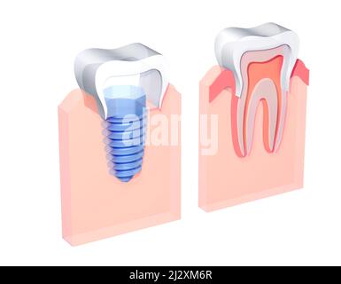 3D Darstellung eines Zahnimplantats in einem Zahnfleisch, neben einem normalen Zahn. Ixometrischer Grafikstil. Transparentes anatomisches Bild auf weißem Hintergrund. Stockfoto