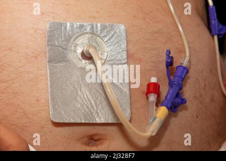 Die perkutane endoskopische Gastrostomie (PEG) ist ein endoskopisches medizinisches Verfahren, bei dem ein Schlauch (PEG-Schlauch) über den in den Magen des Patienten geleitet wird Stockfoto