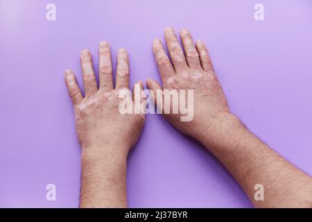 Zeigt Vitiligo Problem Hände auf lila Hintergrund. Pigmentationsproblem der Haut. Hochwertige Fotos Stockfoto