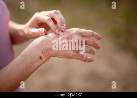 Nahaufnahme Dermatitis auf der Haut, krank allergischer Ausschlag Ekzem Haut des Patienten, atopische Dermatitis Symptom Haut Detail Textur, Pilz der Haut, das Konzept de Stockfoto