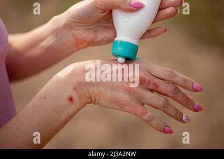Ekzem an den Händen. Die Frau Anwendung der Salbe , Cremes bei der Behandlung von Ekzemen, Psoriasis und anderen Hautkrankheiten. Konzept für Hautprobleme. Stockfoto