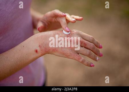 Ekzem an den Händen. Die Frau Anwendung der Salbe , Cremes bei der Behandlung von Ekzemen, Psoriasis und anderen Hautkrankheiten. Konzept für Hautprobleme. Stockfoto