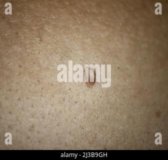 Großes Papilloma auf der Haut der Frau. Medizinische Gesundheit Foto. Dermatologieproblem. Nahaufnahme Stockfoto
