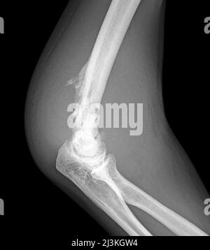 Osteosarkom des distalen Humerus, Röntgen Stockfoto
