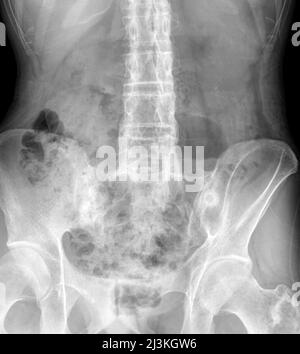 Spondylitis ankylosans, Röntgen Stockfoto