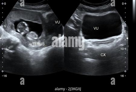 16-wöchiger, Ultraschalluntersuchung des alten Stockfoto