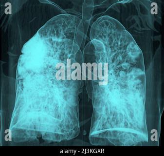 Covid-19 Pneumonie, 3D CT-Scan Stockfoto
