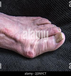 Älterer Pflegeheim, der seine Bunions ....progressive-Deformität in seinem Fall vererbt zeigte Stockfoto