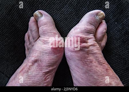 Altenpflegeheim, der seine Verformung der Bunions ....progressive zeigte, in seinem Fall geerbt. Stockfoto